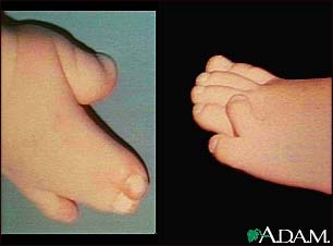 Syndactyly