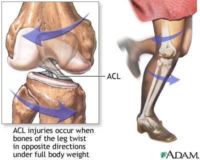 ACL injury