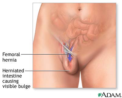 Femoral hernia