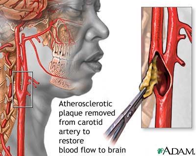 Endarterectomy