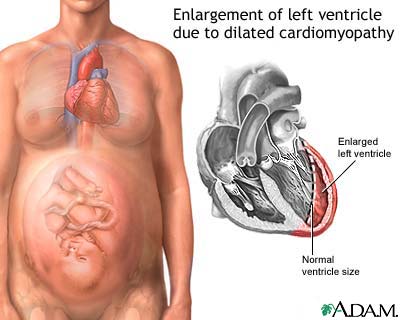 Peripartum cardiomyopathy