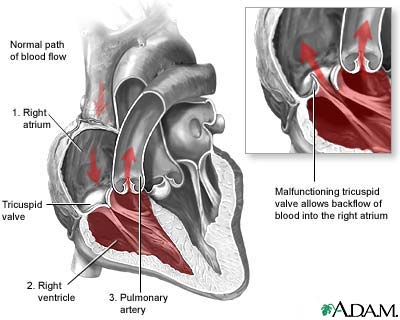 Tricuspid Regurgitation