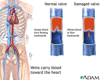 Venous insufficiency