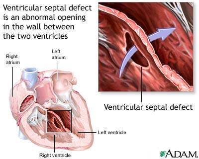 Ventricular septal defect