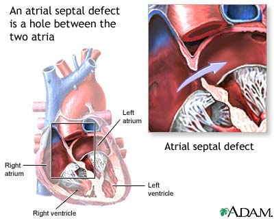 Atrial septal defect