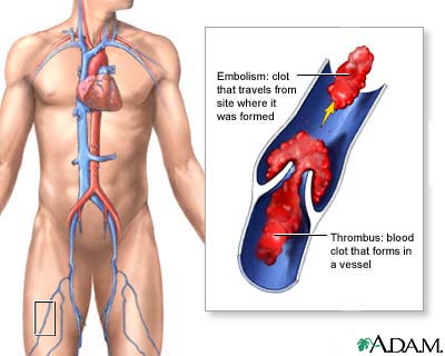 Thrombus