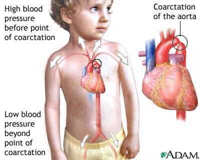 Coarctation of the aorta