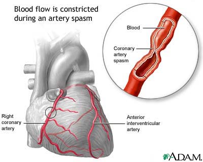 Coronary artery spasm