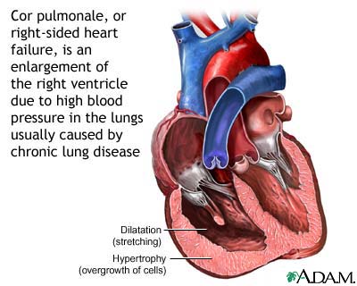 Cor pulmonale