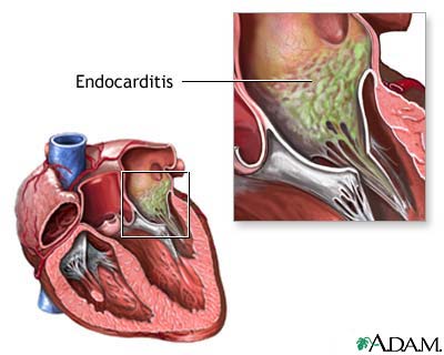 Culture-negative endocarditis