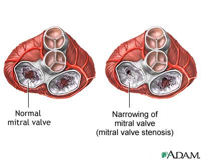 Mitral stenosis