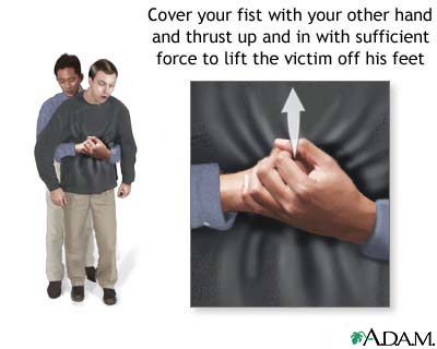 Heimlich maneuver on an adult