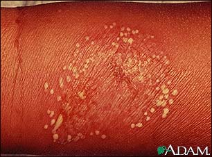 Pustules, superficial on the arm