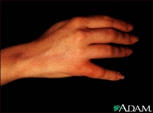 Staphylococcal lymphangitis