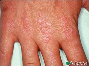 Dermatomyositis, Gottron's papules on the hand