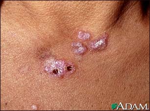 Lupus, discoid - view of lesions on the chest