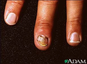 Nail infection, candidal