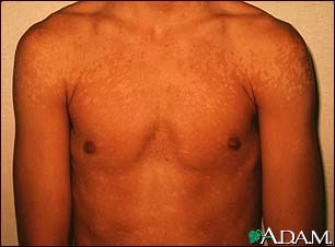 Tinea versicolor - shoulders