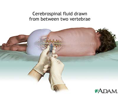 Lumbar puncture (spinal tap)