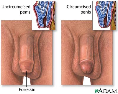 Circumcised vs. uncircumcised