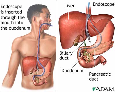 ERCP