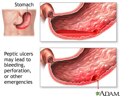 Ulcer emergencies