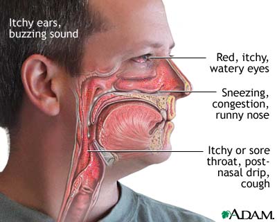 Allergy symptoms