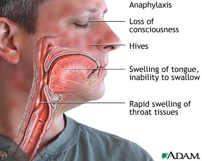 Anaphylaxis