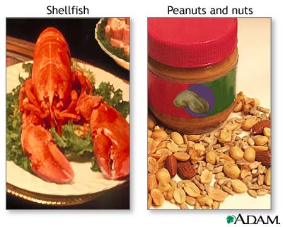 Food allergies