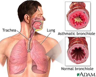 Asthmatic bronchiole and normal bronchiole