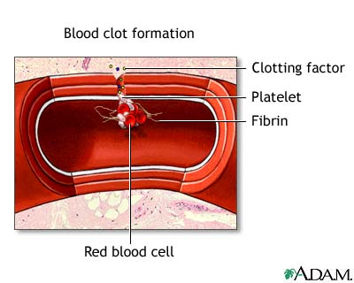 Blood clot formation