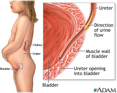 Vesicoureteral reflux