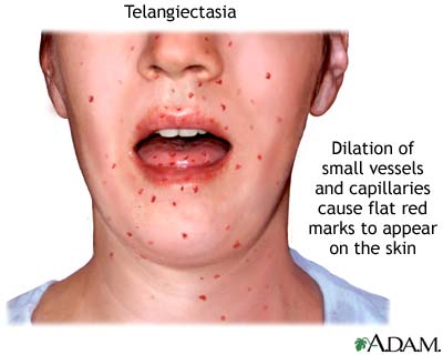 Telangiectasia