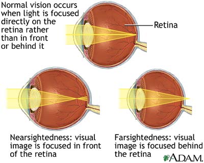 Normal, near, and farsightedness