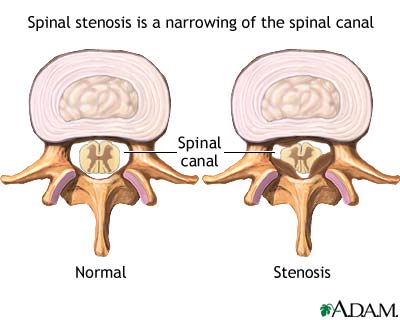 Spinal stenosis