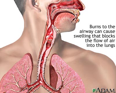 Airway burn