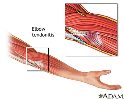 Tendonitis