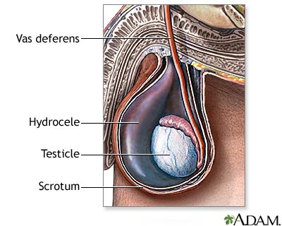 Hydrocele