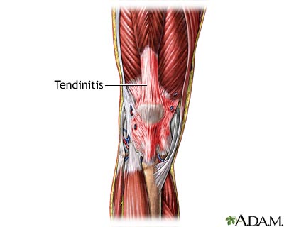 Tendinitis