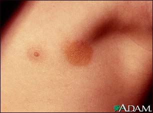 Urticaria pigmentosa in the armpit