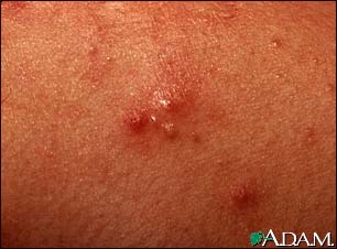 Acne - close-up of pustular lesions