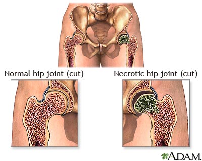 Aseptic necrosis