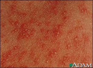 Erythema toxicum neonatorum - close-up