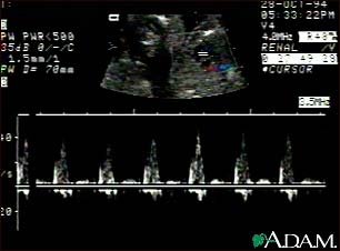 Ultrasound, normal fetus - heartbeat