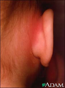 Mastoiditis - redness and swelling behind ear