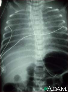 Totally anomalous pulmonary venous return, X-ray