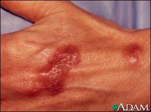 Mycobacterium marinum infection on the hand