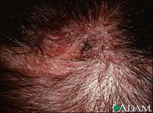 Ringworm, tinea capitis - close-up