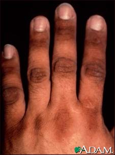 Acanthosis nigricans on the hand