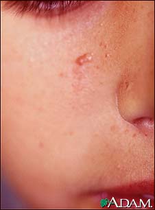 Tuberous sclerosis, angiofibromas - face